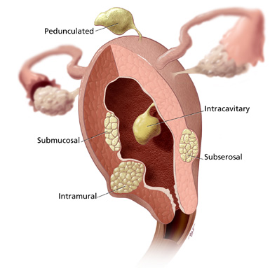 myomectomy-uterine-fibroids-en, da vinci Myomectomy Miami