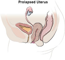 sacrocolpopexy-pelvic-prolapse-after-en, uterine prolapse treatment 