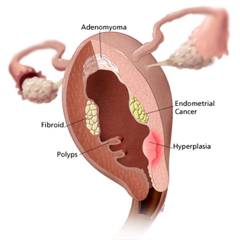 uterine-fibroid-anatomy-en, heavy bleeding during period