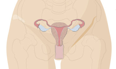 uterus-hysterectomy, Types of Hysterectomy procedures Miami